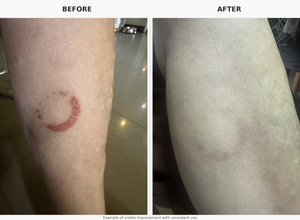 Stretch Marks & Scars Tissue Oil – 100ml